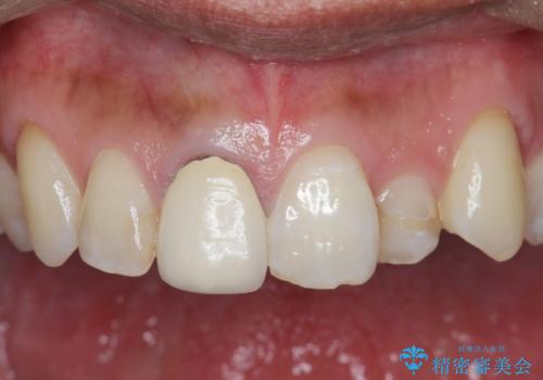 奥に引っ込んでいる前歯を並べたい 矯正治療とセラミック治療の治療前