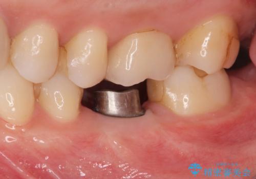 欠損部のインプラント補綴の治療中