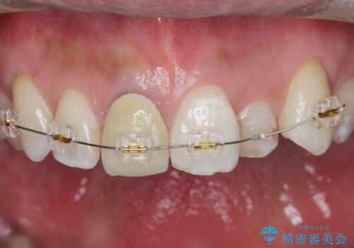 奥に引っ込んでいる前歯を並べたい 矯正治療とセラミック治療の治療中