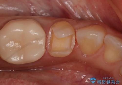 銀歯を白くしたい セラミックインレーの治療中
