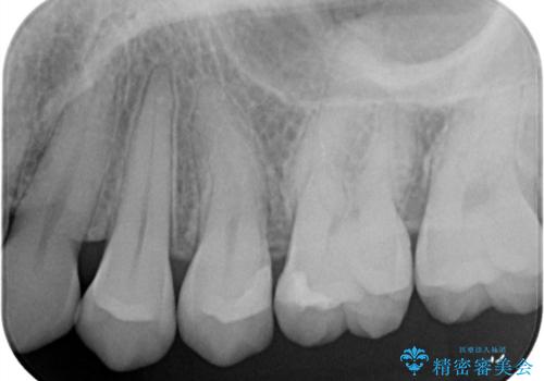 セラミックインレー 虫歯の治療の治療後
