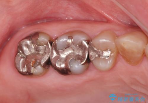 歯周ポケットの除去と再補綴治療の治療前