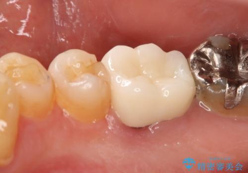 保険材料をセラミックにやり変えたい セラミックインレーの治療前