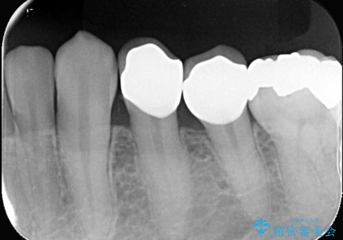 CRの劣化による虫歯|虫歯治療|セラミッククラウン|審美回復|神経を残す治療の治療後