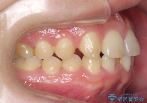 前歯のすき間 歯のがたつきの治療前