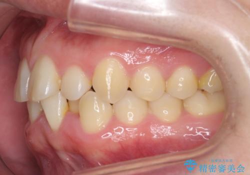 前歯のすき間 歯のがたつきの治療前