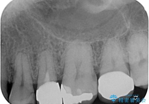 物が詰まる オールセラミッククラウンの治療後