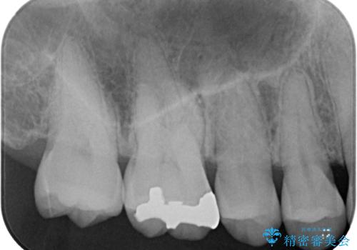 上の銀歯をやり替えたい セラミックインレー修復の治療前