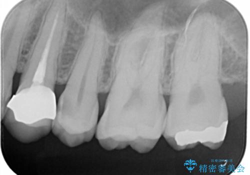 う蝕除去中に露髄 フルジルコニアクラウンの治療前