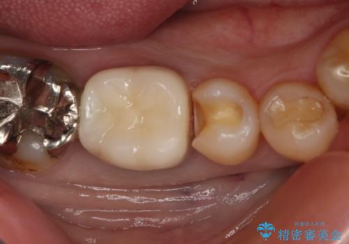 保険材料をセラミックにやり変えたい セラミックインレーの治療中