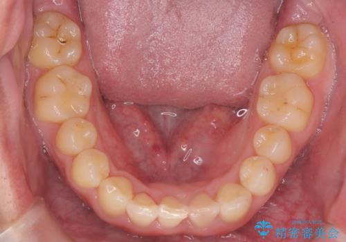 前歯のすき間 歯のがたつきの治療中