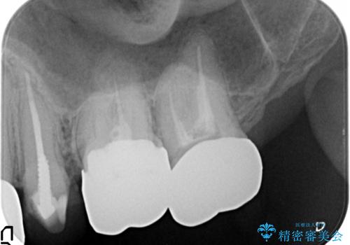 虫歯だらけの歯を治療したいの治療前
