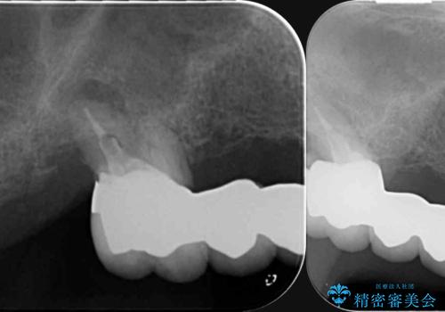 歯がずっと疼く 根本的な治療の希望の治療前