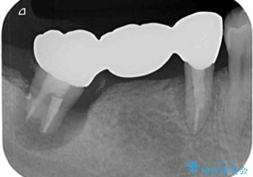 奥歯がぐらぐらする インプラントによる補綴治療の治療前