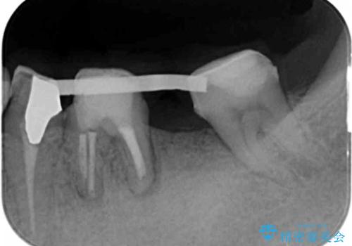 歯ブラシのしやすい環境を整えるインプラント治療の治療前