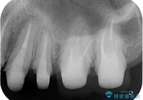 虫歯だらけの歯を治療したいの治療中