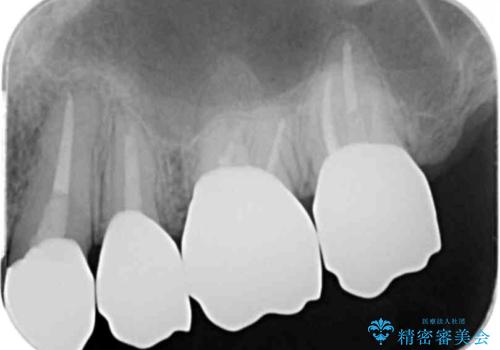 虫歯だらけの歯を治療したいの治療後