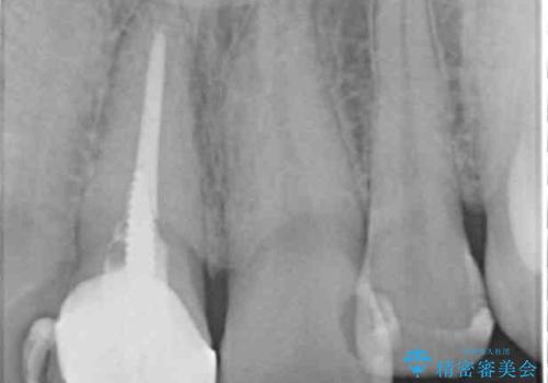 奥に引っ込んでいる前歯を並べたい 矯正治療とセラミック治療の治療前