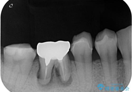 破折して抜歯が必要となった奥歯 オールセラミックブリッジ治療の治療前