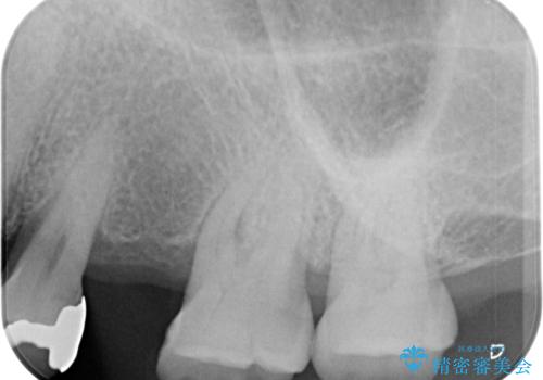 手術が怖くて抜いたままの奥歯に歯を 1DAYインプラント治療の治療前