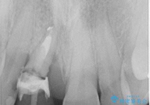 首の皮一枚で繋がっている前歯 1DAYインプラントでスムーズに治療の治療前