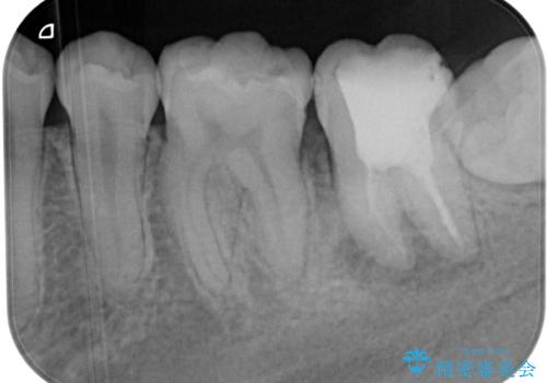 噛むと痛い 奥歯のむし歯治療の治療前