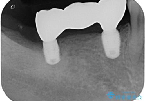 奥歯がぐらぐらする インプラントによる補綴治療の治療後