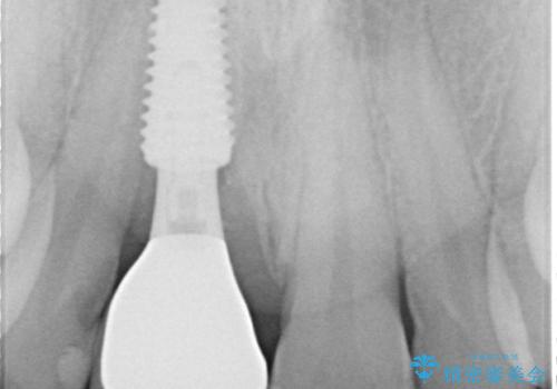 首の皮一枚で繋がっている前歯 1DAYインプラントでスムーズに治療の治療後