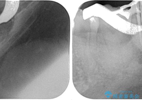 噛むと痛い 奥歯のむし歯治療の治療中