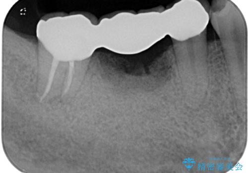 破折して抜歯が必要となった奥歯 オールセラミックブリッジ治療の治療後