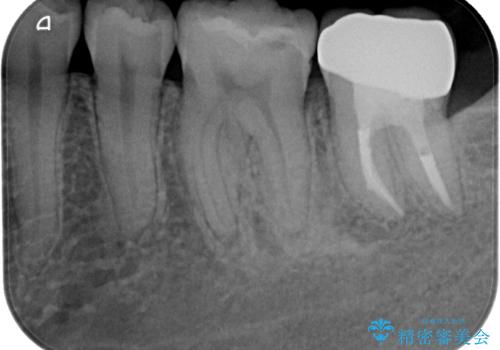 噛むと痛い 奥歯のむし歯治療の治療後