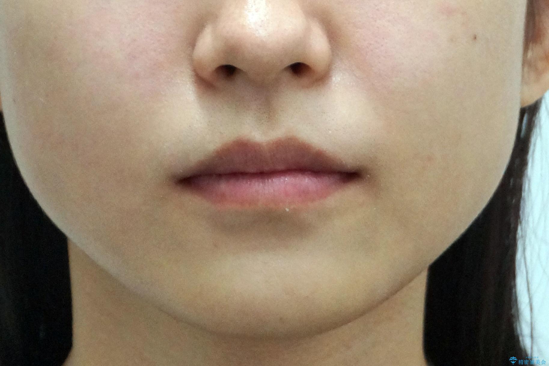 前歯のがたつき 保険治療の前歯の被せ物もやりかえたいの治療前(顔貌)