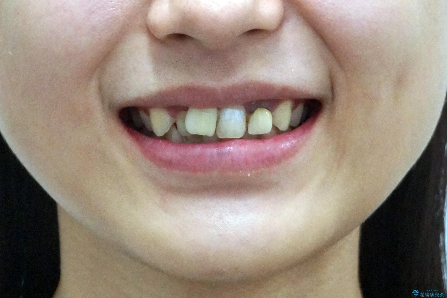 前歯のがたつき 保険治療の前歯の被せ物もやりかえたいの治療前(顔貌)