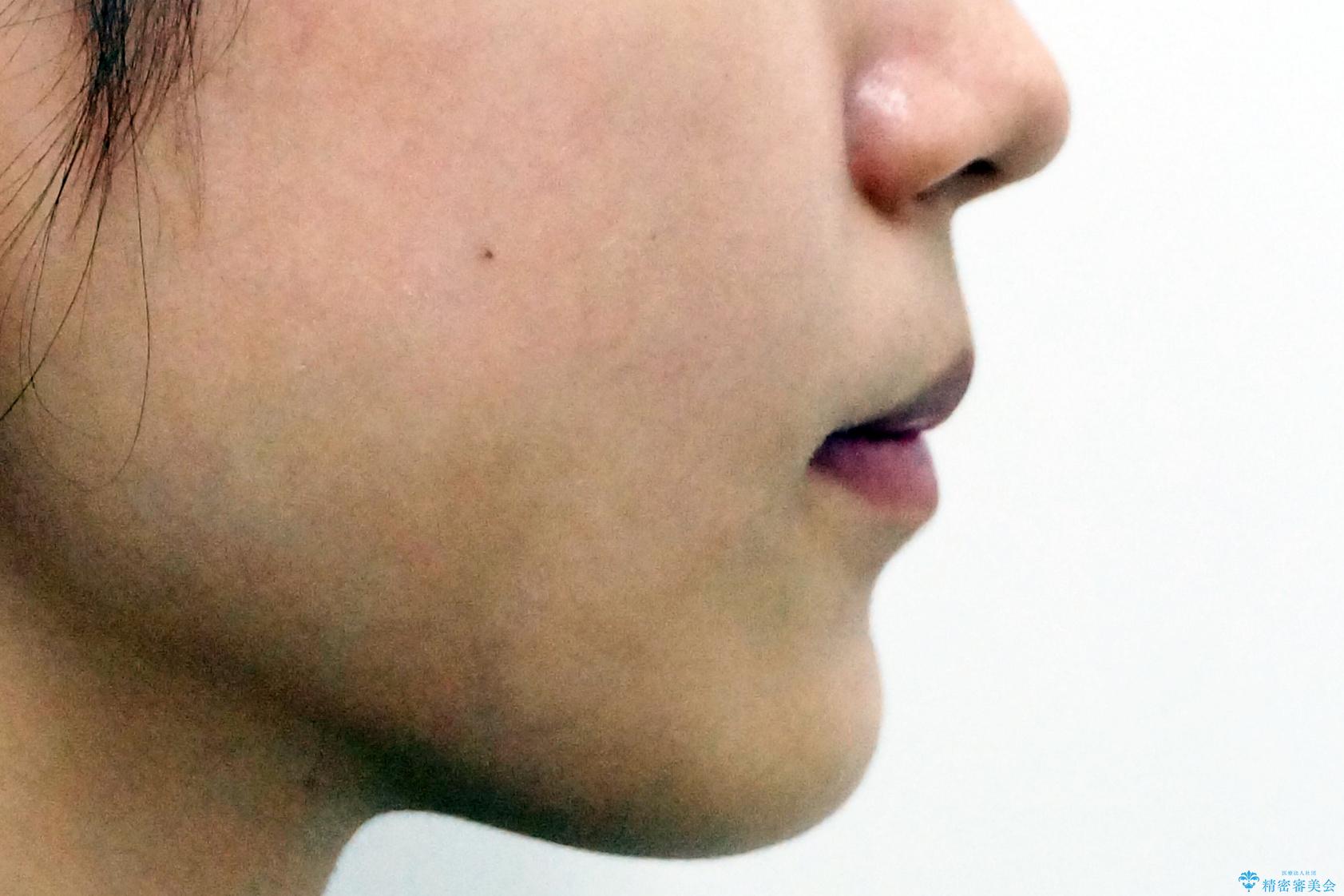 前歯のがたつき 保険治療の前歯の被せ物もやりかえたいの治療前(顔貌)