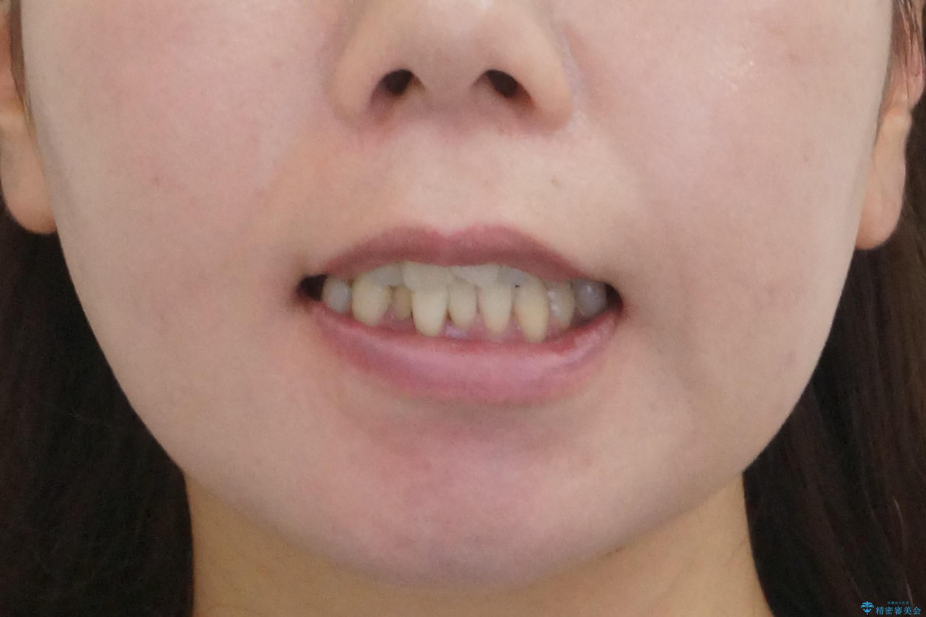 奥歯が倒れてしまっている 親知らずを利用した矯正の治療前(顔貌)
