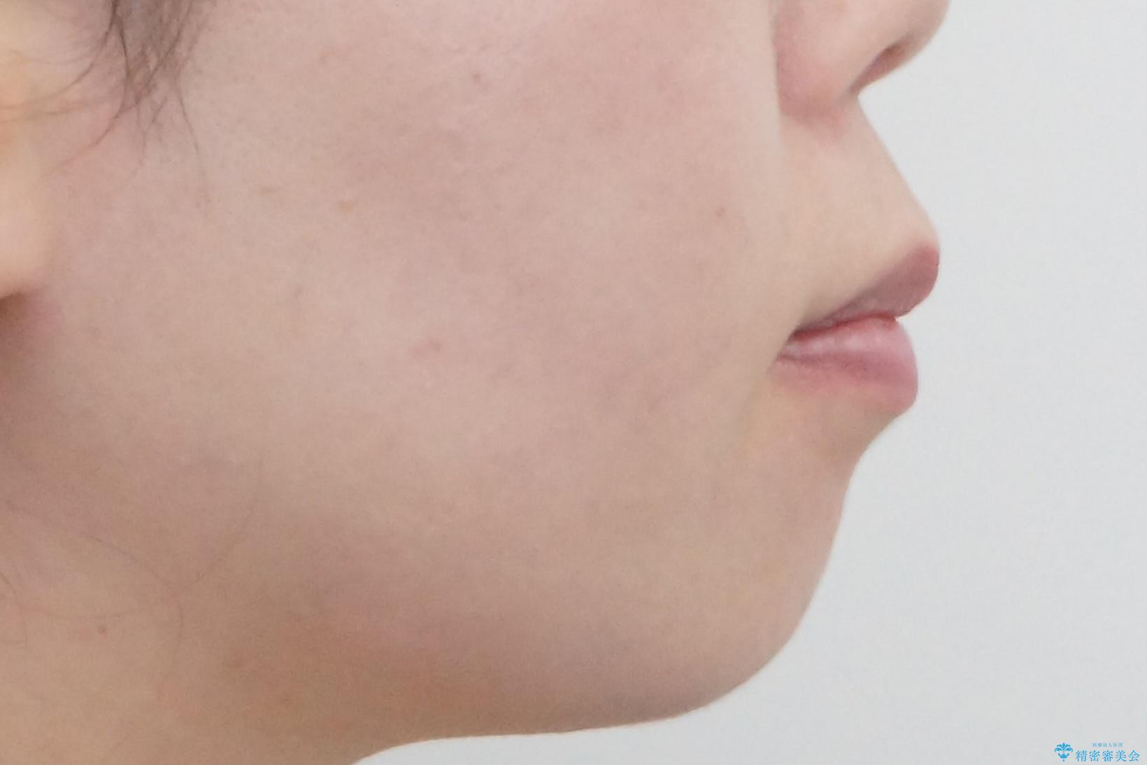 奥歯が倒れてしまっている 親知らずを利用した矯正の治療前(顔貌)