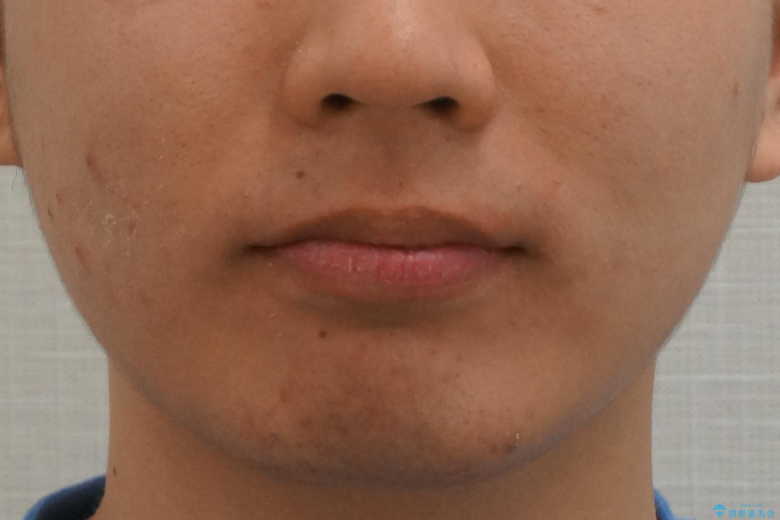 出っ歯の治療 インビザラインで抜歯矯正 親知らずを使用した矯正の治療前(顔貌)