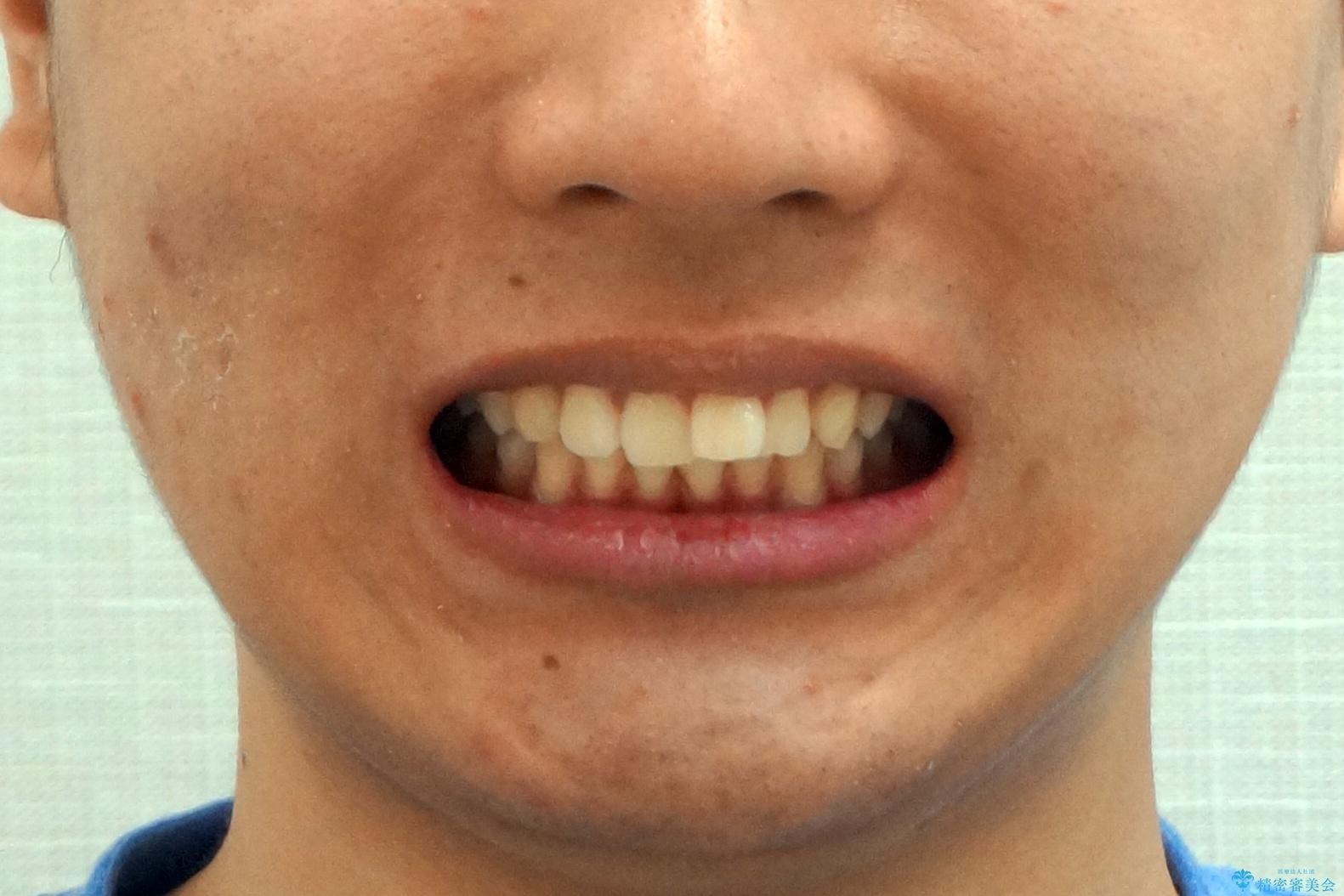 出っ歯の治療 インビザラインで抜歯矯正 親知らずを使用した矯正の治療前(顔貌)