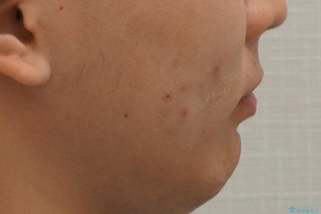 出っ歯の治療 インビザラインで抜歯矯正 親知らずを使用した矯正の治療前(顔貌)