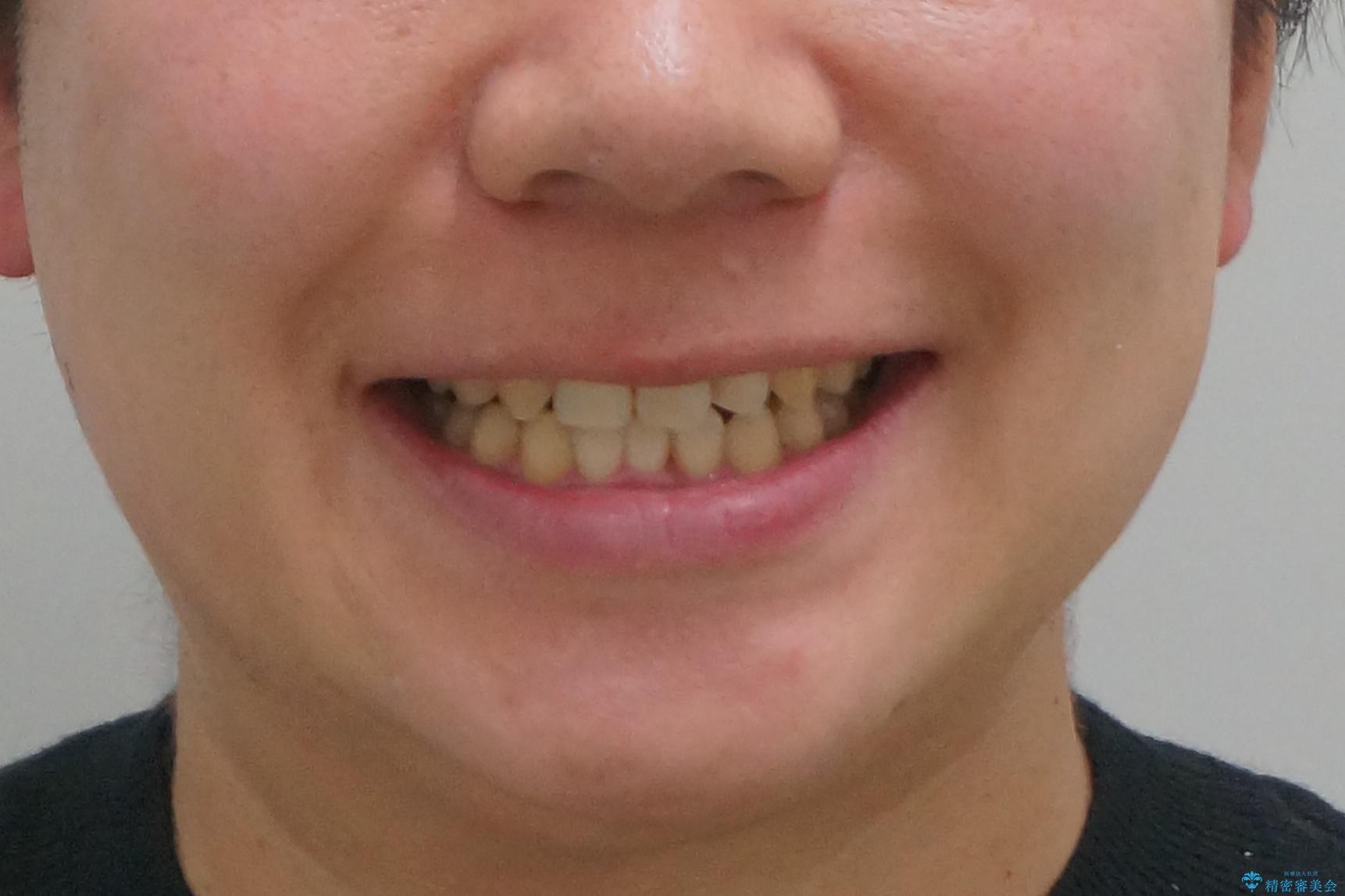 前歯のすき間 歯のがたつきの治療後(顔貌)