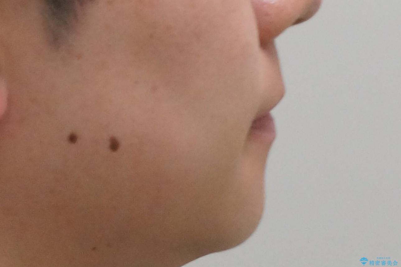 前歯のすき間 歯のがたつきの治療後(顔貌)