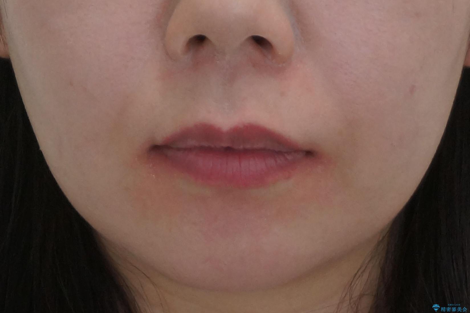 奥歯が倒れてしまっている 親知らずを利用した矯正の治療後(顔貌)