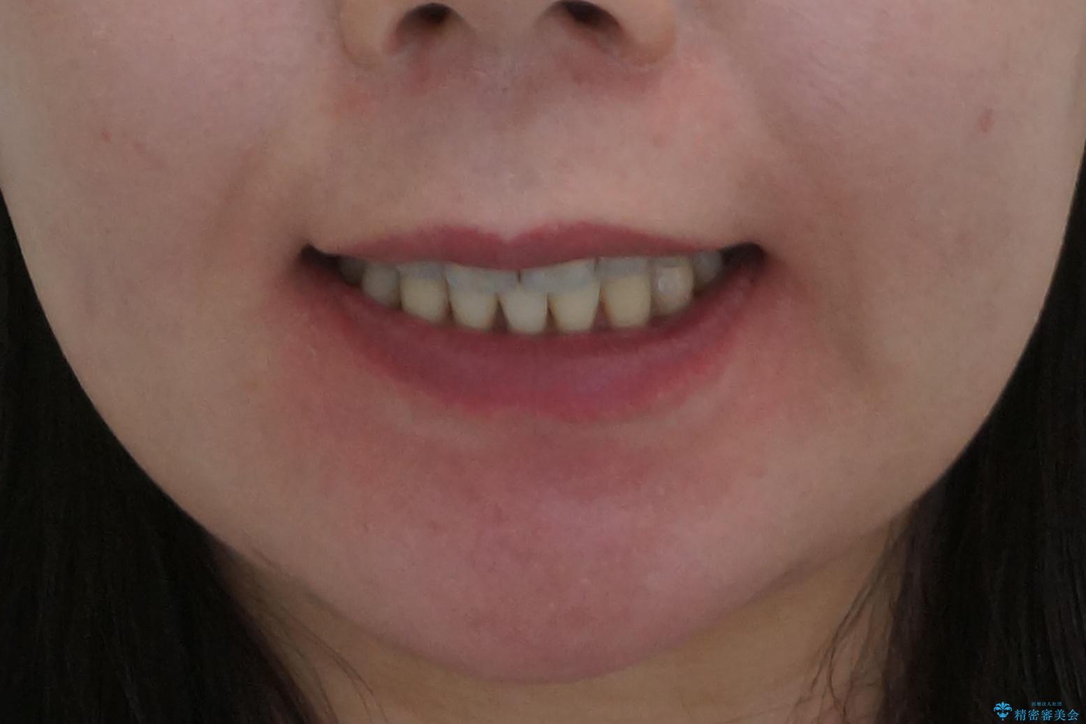 奥歯が倒れてしまっている 親知らずを利用した矯正の治療後(顔貌)