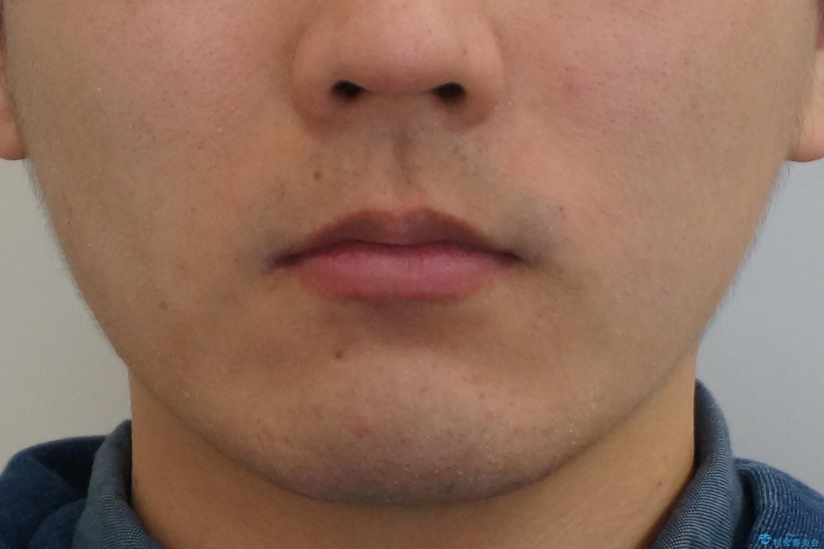 出っ歯の治療 インビザラインで抜歯矯正 親知らずを使用した矯正の治療後(顔貌)