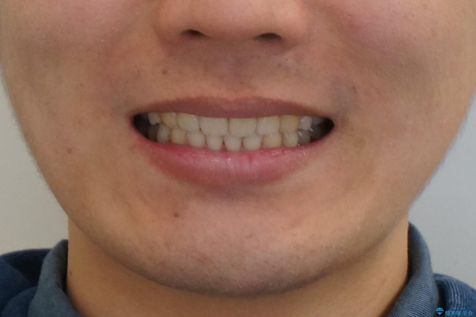 出っ歯の治療 インビザラインで抜歯矯正 親知らずを使用した矯正の治療後(顔貌)