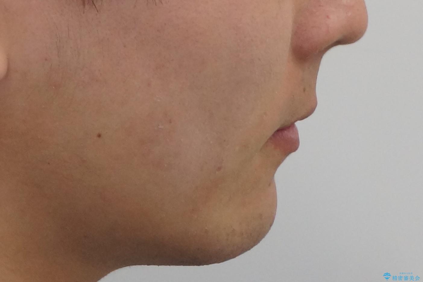 出っ歯の治療 インビザラインで抜歯矯正 親知らずを使用した矯正の治療後(顔貌)