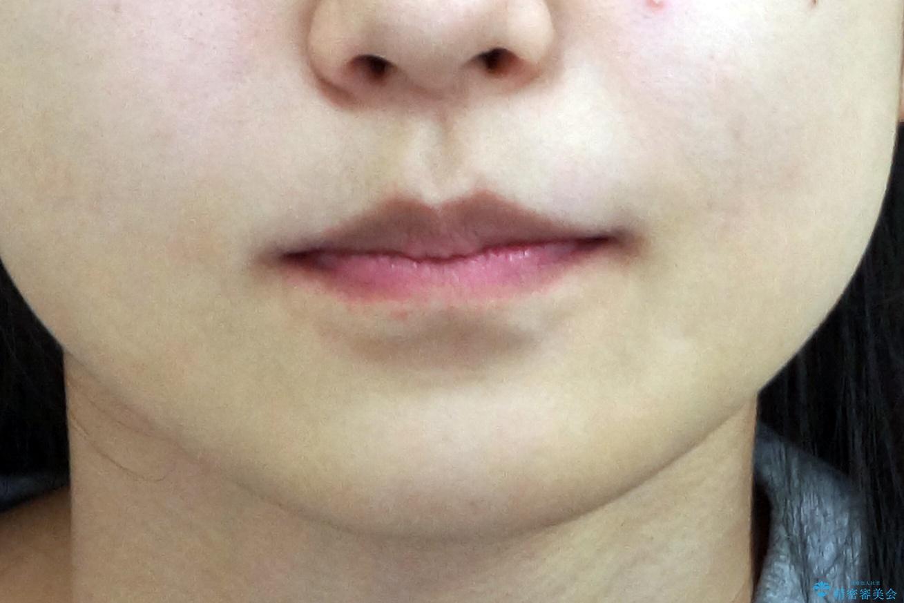 前歯のがたつき 保険治療の前歯の被せ物もやりかえたいの治療後(顔貌)