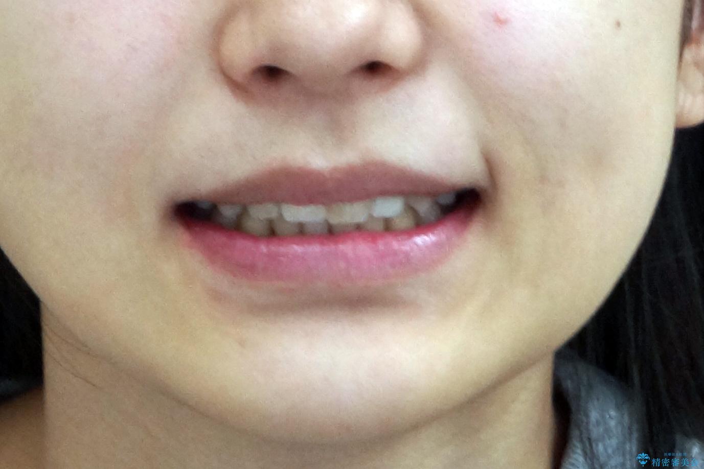 前歯のがたつき 保険治療の前歯の被せ物もやりかえたいの治療後(顔貌)