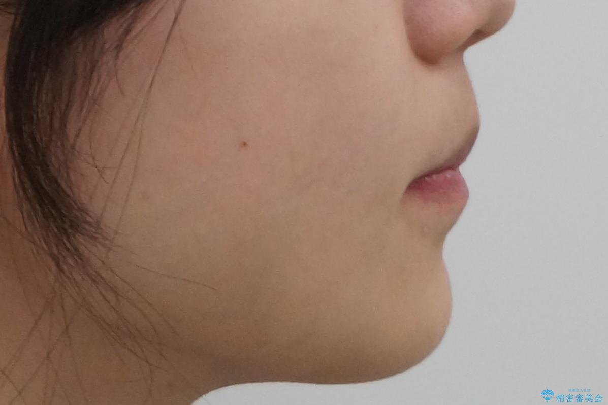 前歯のがたつき 保険治療の前歯の被せ物もやりかえたいの治療後(顔貌)