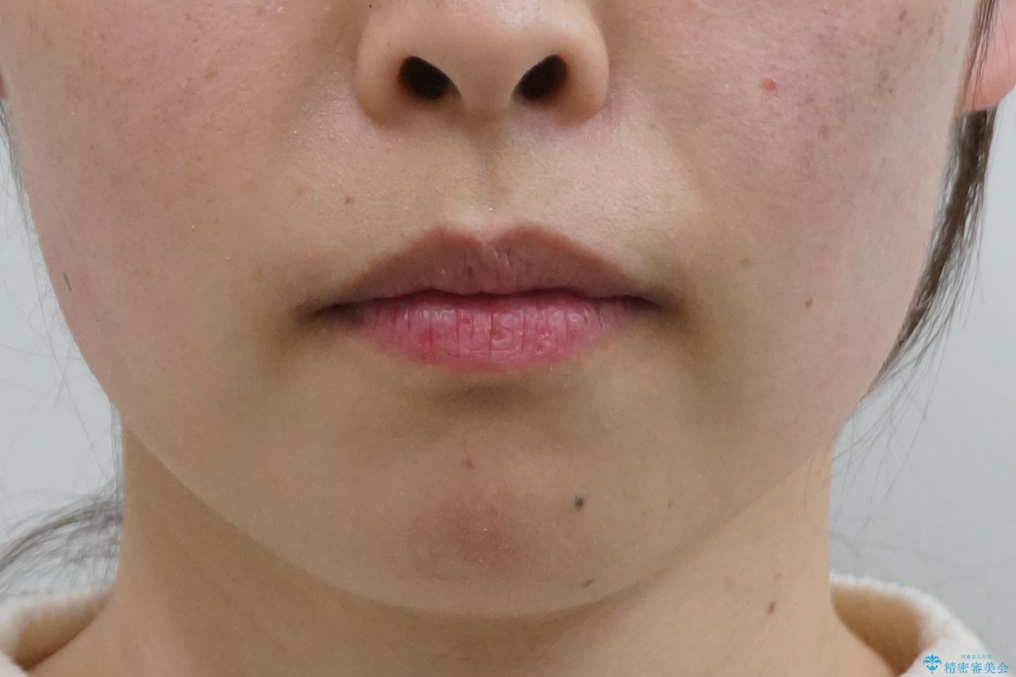 出っ歯の治療 抜かずに 短期間で目立たない治療の治療後(顔貌)